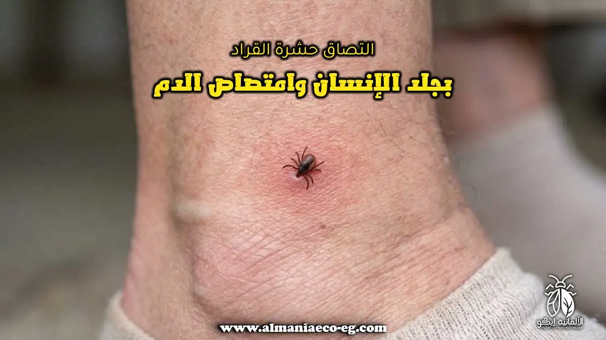 التصاق حشرة القراد بجلد الإنسان وامتصاص الدم