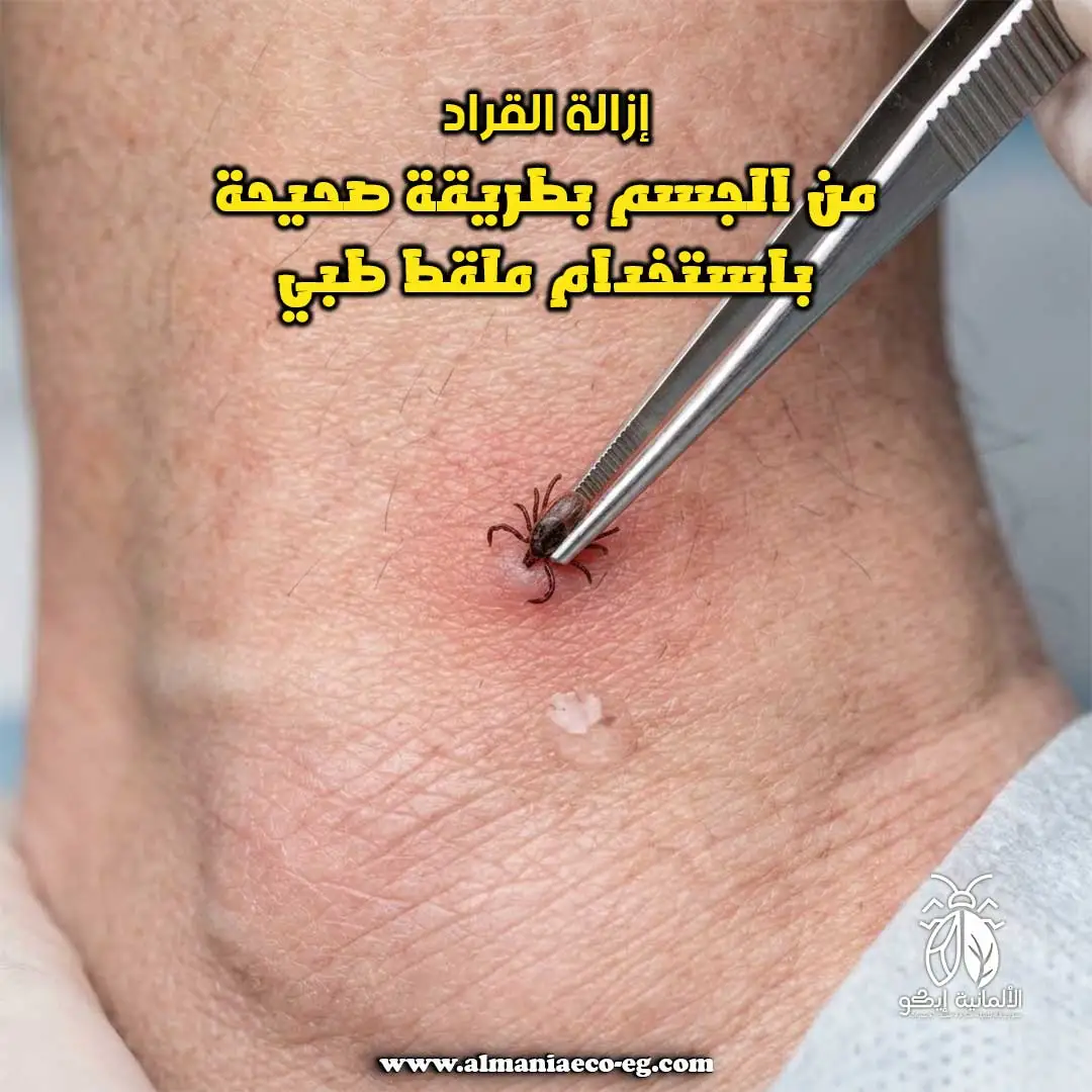 إزالة القراد من الجسم بطريقة صحيحة باستخدام ملقط طبي
